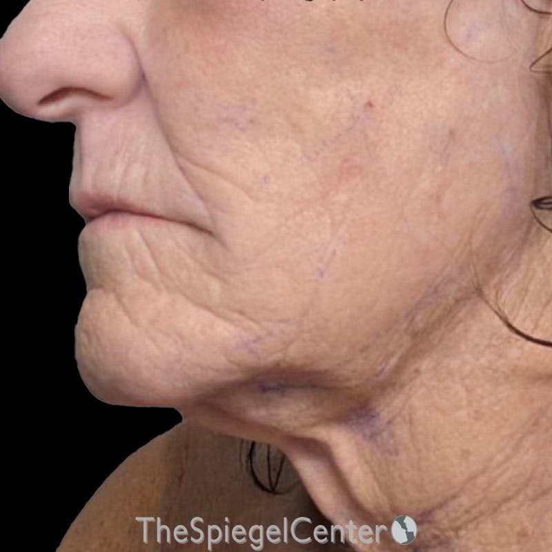 Junera Before & After Gallery - Patient 150424 - Image 2