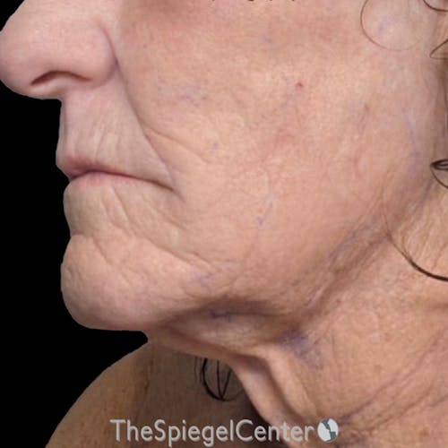 Junera Before & After Gallery - Patient 150424 - Image 2