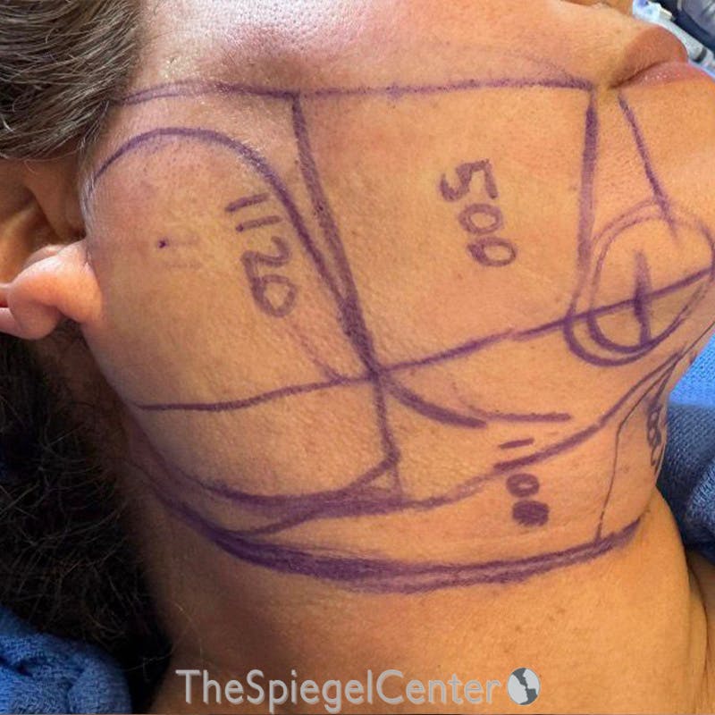 Junera Before & After Gallery - Patient 233118 - Image 1