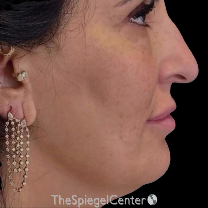 Junera Before & After Gallery - Patient 114346 - Image 1