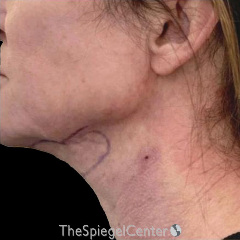 Junera Before & After Gallery - Patient 213576 - Image 2
