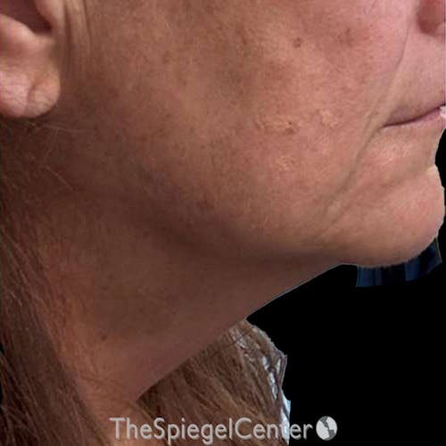 Junera Before & After Gallery - Patient 344086 - Image 2
