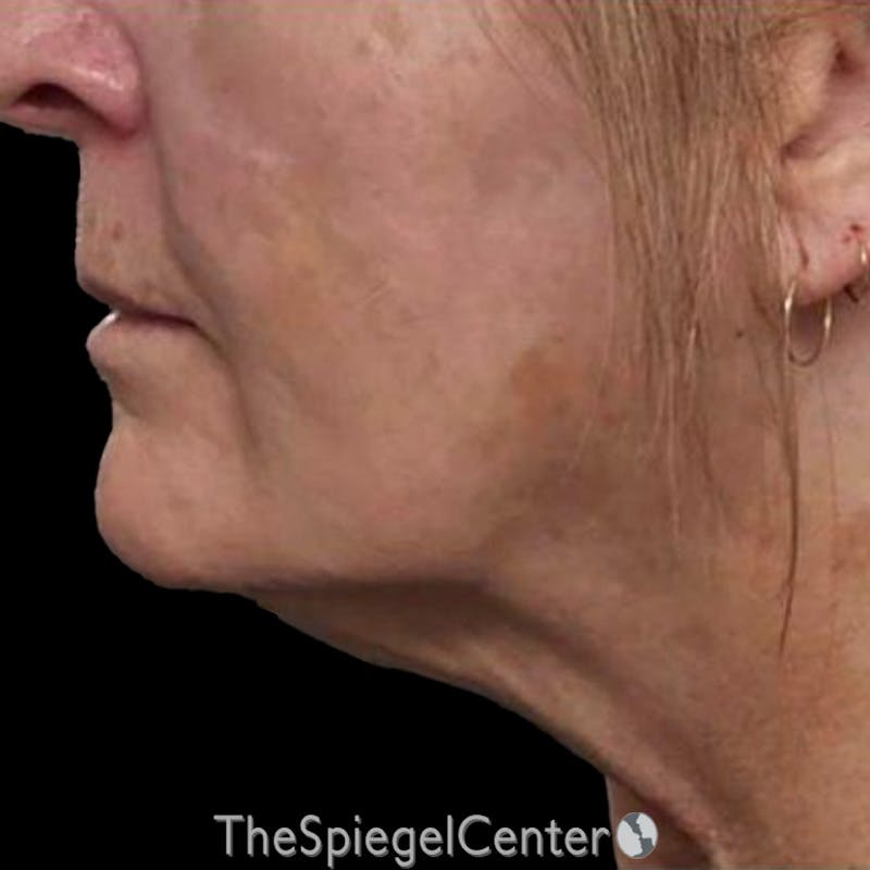 Junera Before & After Gallery - Patient 336306 - Image 2