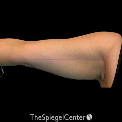Junera Before & After Gallery - Patient 971481 - Image 2