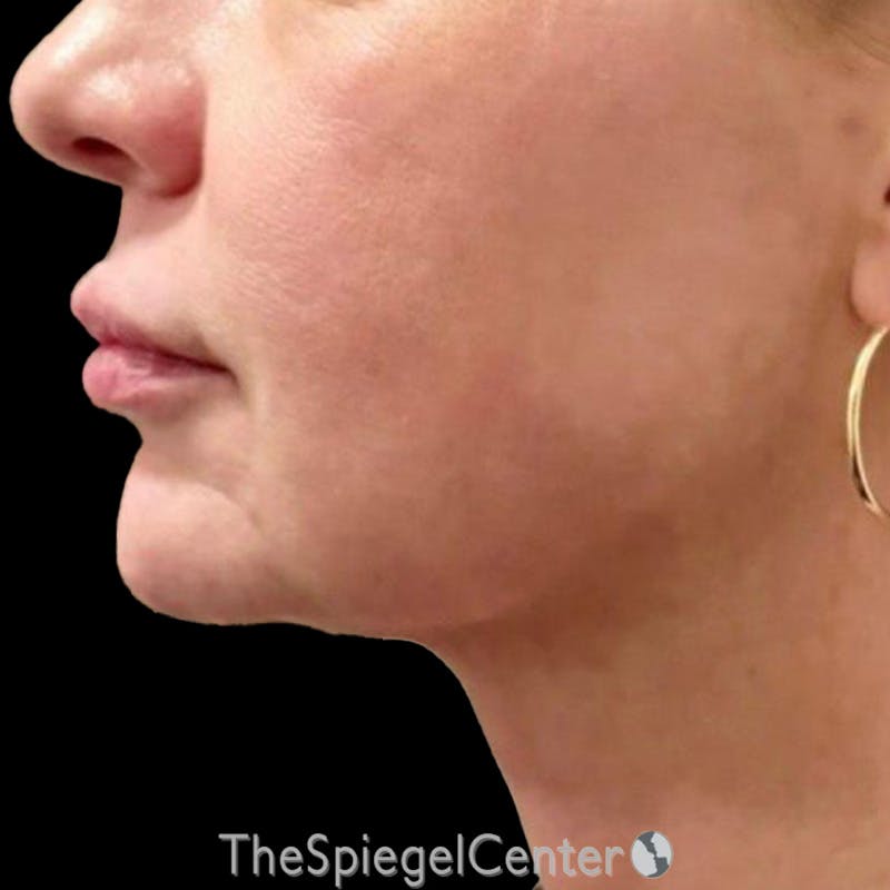Junera Before & After Gallery - Patient 186119 - Image 2