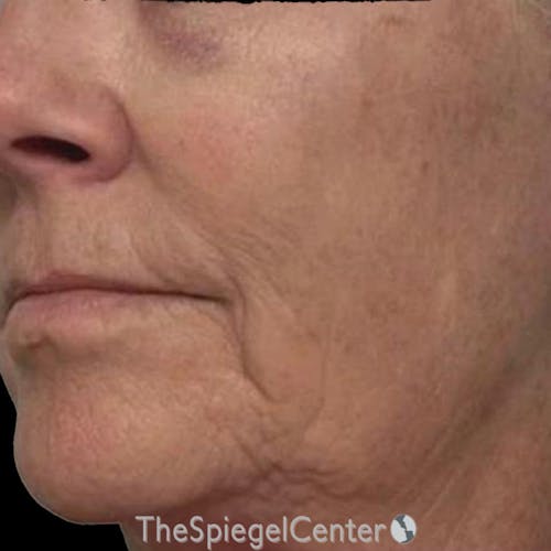 Junera Before & After Gallery - Patient 427355 - Image 2