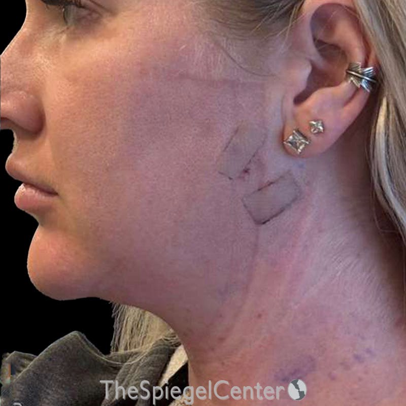 Junera Before & After Gallery - Patient 118641 - Image 2