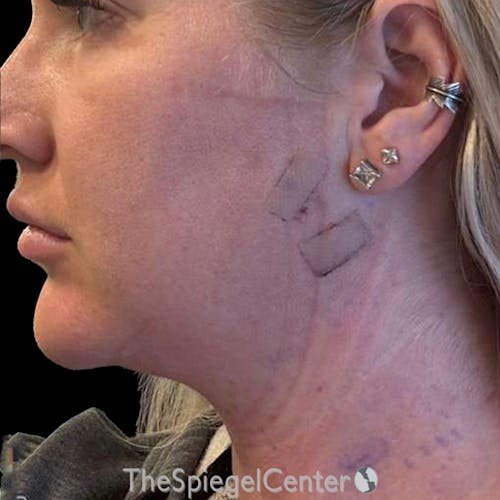 Junera Before & After Gallery - Patient 118641 - Image 2