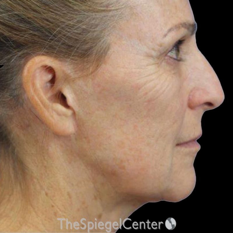 Junera Before & After Gallery - Patient 332387 - Image 1