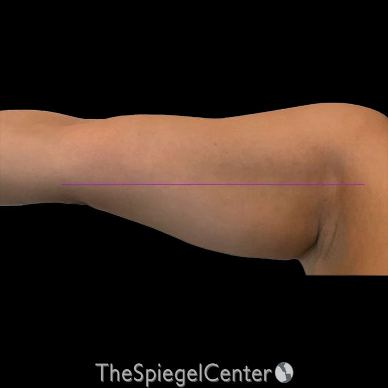 Junera Before & After Gallery - Patient 971481 - Image 1