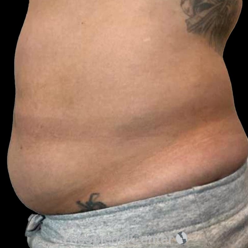 Junera Before & After Gallery - Patient 317227 - Image 1