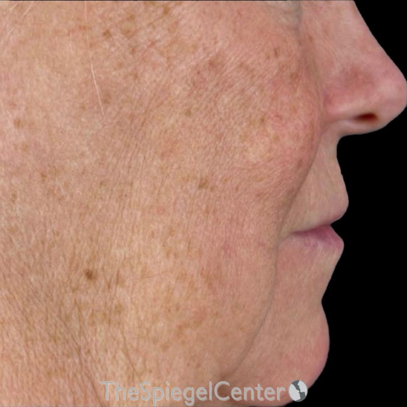 Junera Before & After Gallery - Patient 189961 - Image 1