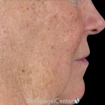 Junera Before & After Gallery - Patient 189961 - Image 1