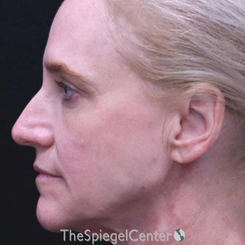 Junera Before & After Gallery - Patient 204764 - Image 2