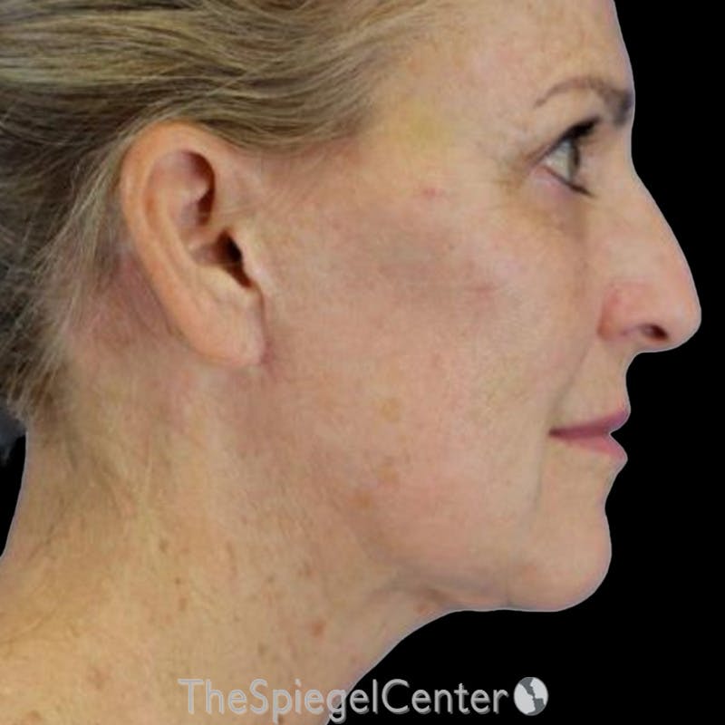 Junera Before & After Gallery - Patient 332387 - Image 2