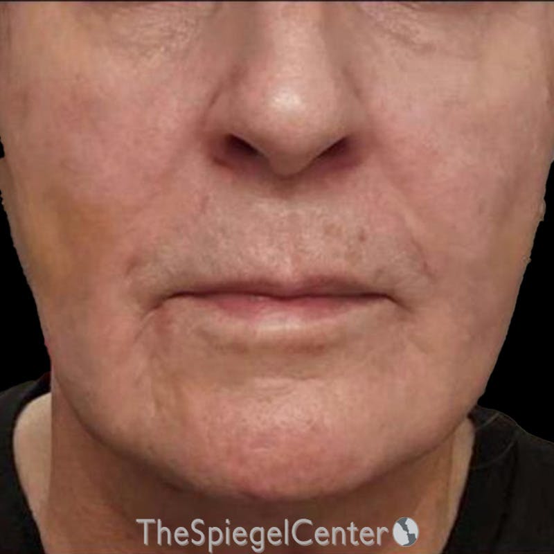 Junera Before & After Gallery - Patient 628581 - Image 2