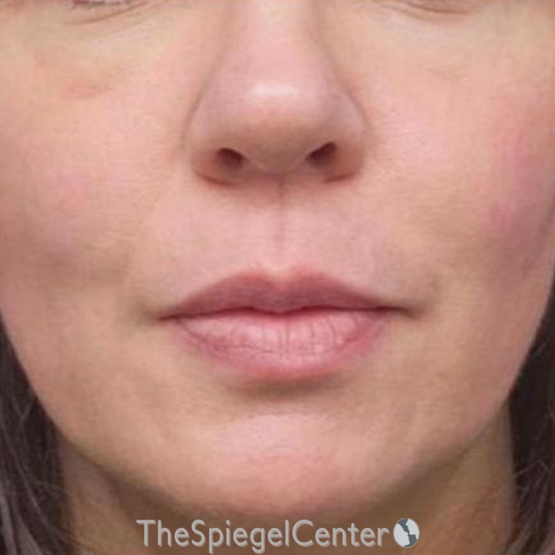 Junera Before & After Gallery - Patient 357178 - Image 2