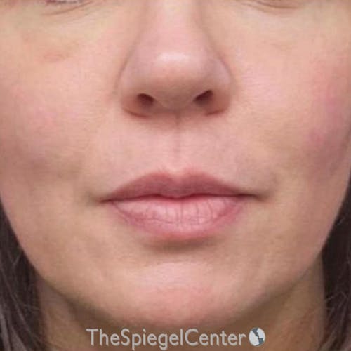 Junera Before & After Gallery - Patient 357178 - Image 2