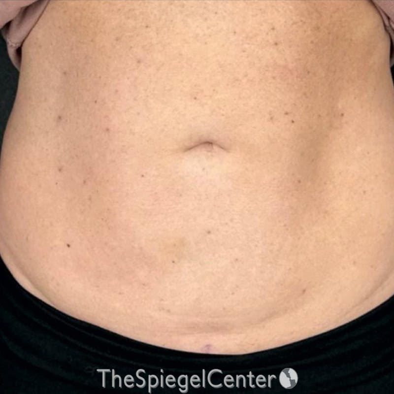 Junera Before & After Gallery - Patient 106203 - Image 2