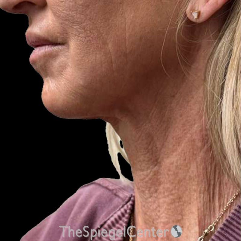 Junera Before & After Gallery - Patient 170512 - Image 2