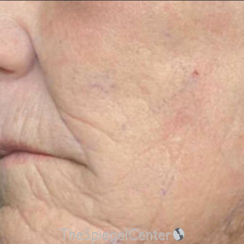 Junera Before & After Gallery - Patient 197741 - Image 2