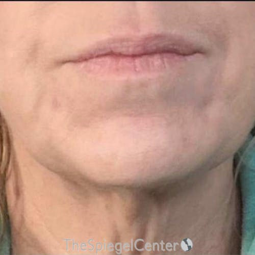 Junera Before & After Gallery - Patient 563833 - Image 2