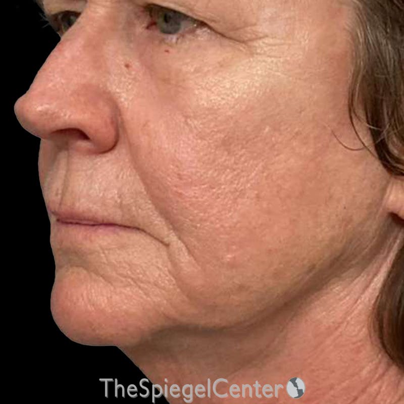 Junera Before & After Gallery - Patient 283417 - Image 2
