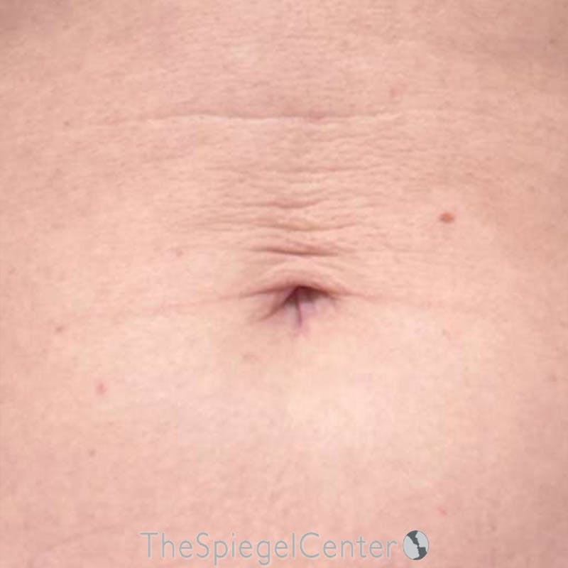 Junera Before & After Gallery - Patient 168875 - Image 1