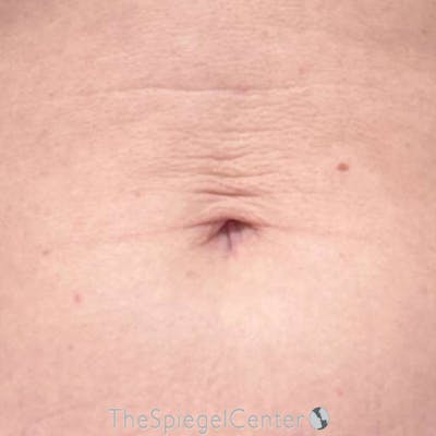 Junera Before & After Gallery - Patient 168875 - Image 1