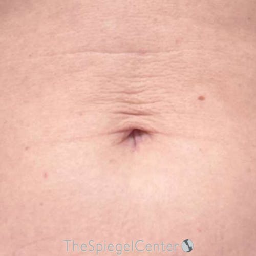 Junera Before & After Gallery - Patient 168875 - Image 1