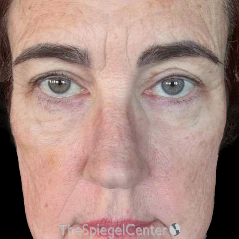 Junera Before & After Gallery - Patient 416137 - Image 2