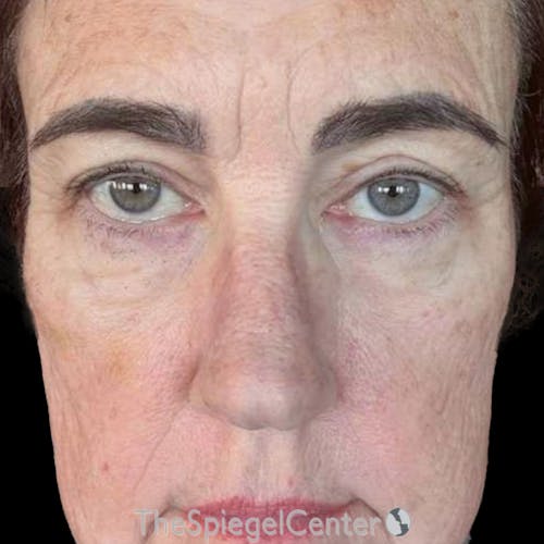 Junera Before & After Gallery - Patient 416137 - Image 2