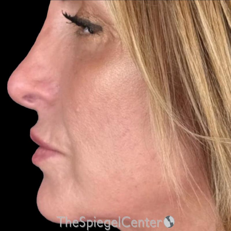 Junera Before & After Gallery - Patient 367109 - Image 2