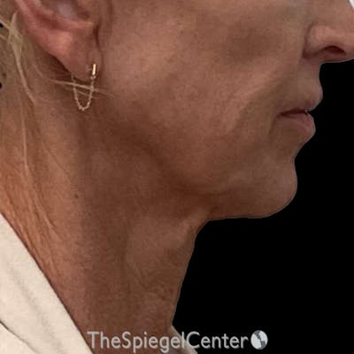 Junera Before & After Gallery - Patient 506294 - Image 1