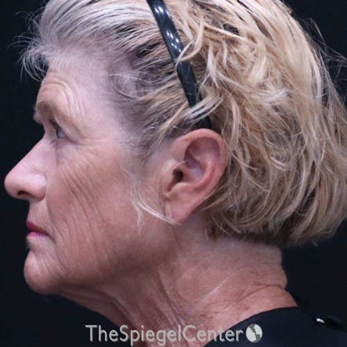 Junera Before & After Gallery - Patient 210006 - Image 1