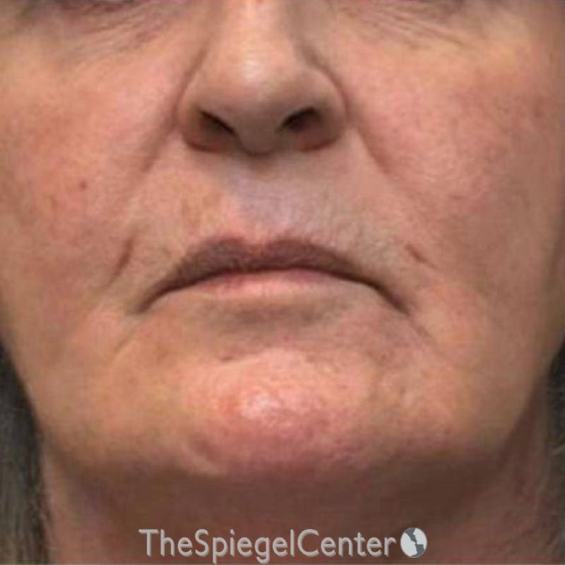 Junera Before & After Gallery - Patient 628581 - Image 1