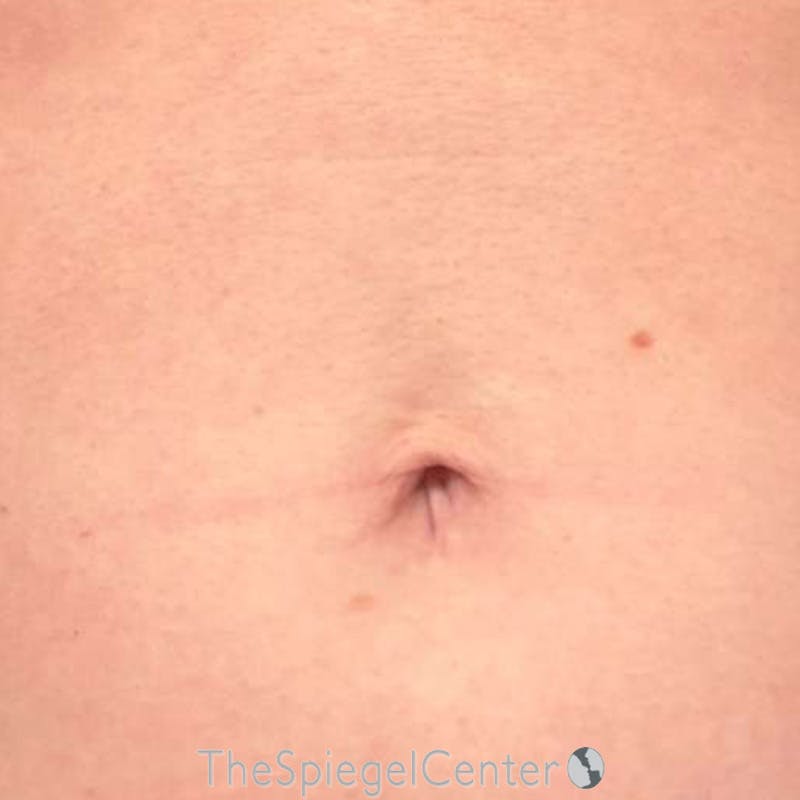 Junera Before & After Gallery - Patient 168875 - Image 2