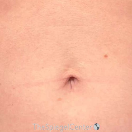 Junera Before & After Gallery - Patient 168875 - Image 2