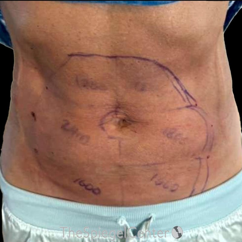Junera Before & After Gallery - Patient 357320 - Image 2
