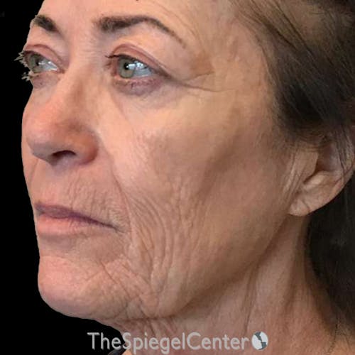Junera Before & After Gallery - Patient 398630 - Image 2