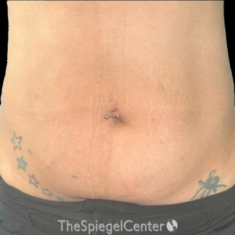 Junera Before & After Gallery - Patient 196099 - Image 2