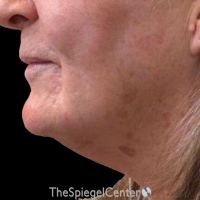 Junera Before & After Gallery - Patient 336306 - Image 1