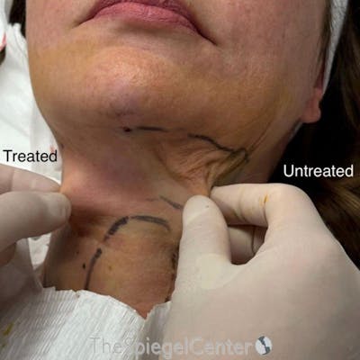 Junera Before & After Gallery - Patient 319628 - Image 1