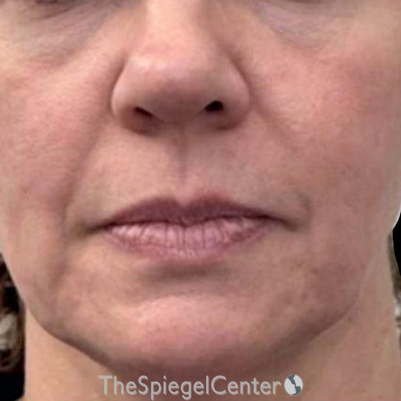 Junera Before & After Gallery - Patient 357178 - Image 1