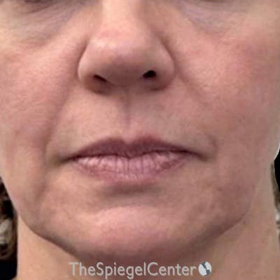 Junera Before & After Gallery - Patient 357178 - Image 1
