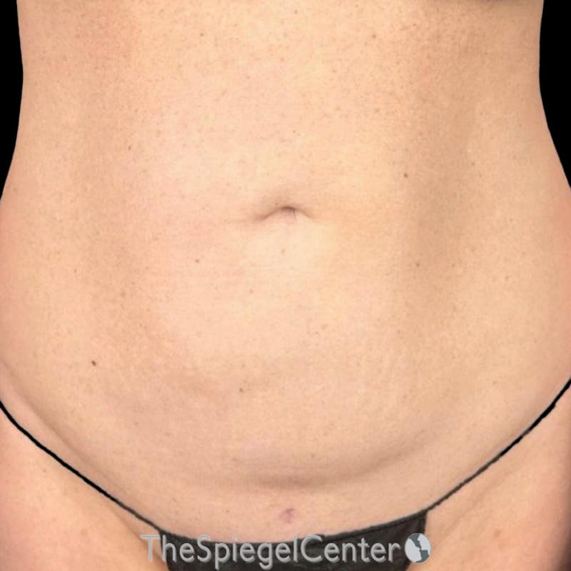 Junera Before & After Gallery - Patient 106203 - Image 1