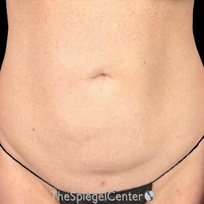 Junera Before & After Gallery - Patient 106203 - Image 1
