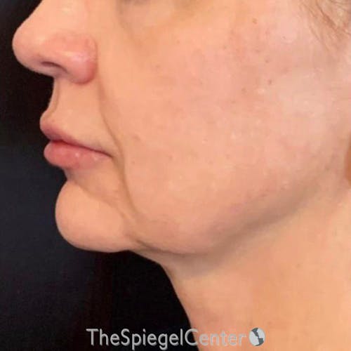 Junera Before & After Gallery - Patient 186119 - Image 1