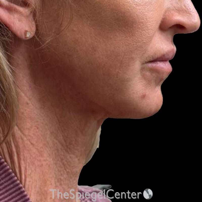 Junera Before & After Gallery - Patient 506294 - Image 2