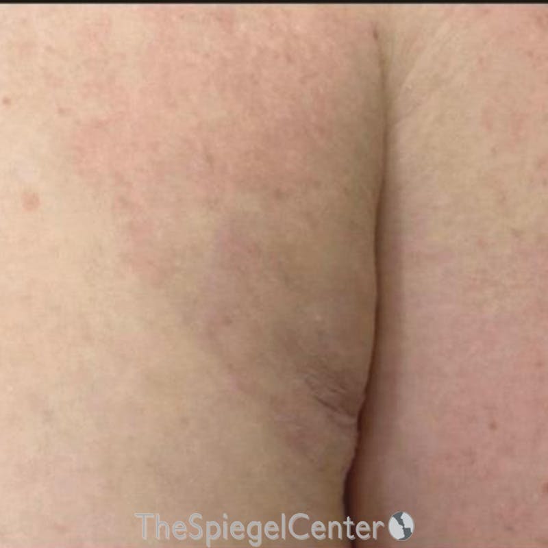 Junera Before & After Gallery - Patient 388110 - Image 2